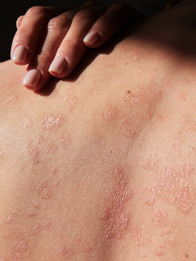 Close up of skin with ecema